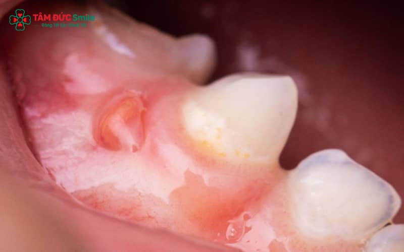 Khi Abc8com giaitri tructuyen bị sưng, đây có thể là dấu hiệu tiềm ẩn cho thấy nướu đang bị viêm hoặc nhiễm trùng