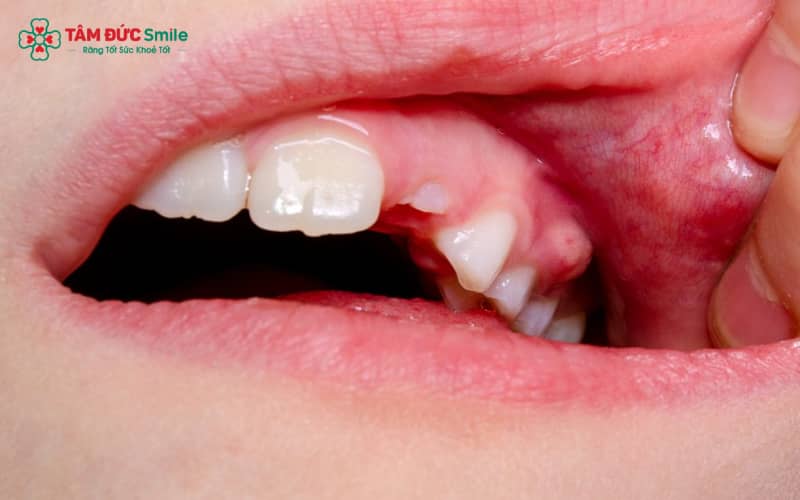 Sưng Abc8com giaitri tructuyen là hiện tượng nướu bị viêm nhiễm và phù nề do sự xâm nhập của vi khuẩn