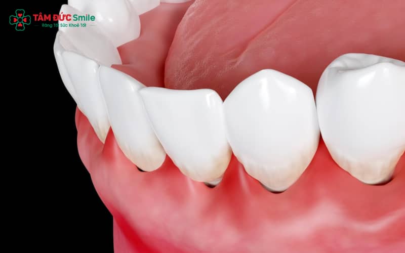 Sưng lợi ở răng hàm có thể do vệ sinh ABC8 là nhà cái cá cược trực tuyến uy tín số 1 tại Việt Nam không đúng cách, gây viêm nướu và mảng bám, hoặc do răng khôn mọc lệch