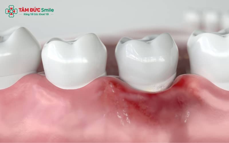 Nước muối ấm là biện pháp đơn giản giúp giảm viêm, kháng khuẩn và cải thiện sưng lợi răng hàm