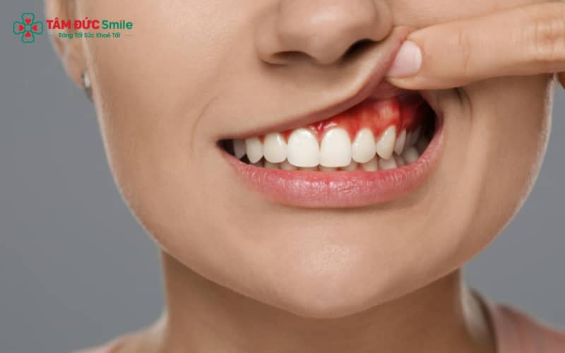 Tình trạng sưng nướu răng thường gây đau, tấy đỏ, xuất huyết nướu và Abc8c1 com thiên đường cá cược hôi