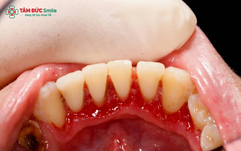 Sưng nướu ở mức độ nhẹ ban đầu có thể biểu hiện bằng nướu hơi đỏ và ê rát