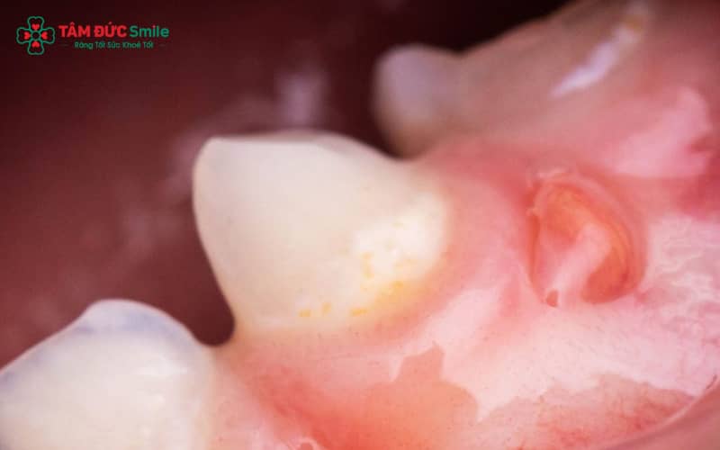 Sưng nướu vùng răng hàm dưới trong cùng thường liên quan đến tình trạng răng khôn mọc lệch, viêm nướu hoặc ABC88 com đăng nhập tiến triển