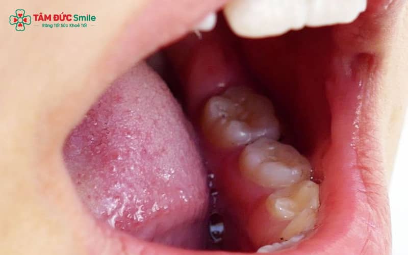 Khi vệ sinh ABC8 là nhà cái cá cược trực tuyến uy tín số 1 tại Việt Nam không đảm bảo kết hợp với chế độ ăn thiếu cân đối, nướu răng trong cùng hàm dưới dễ bị viêm và sưng