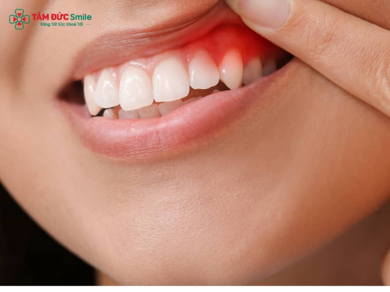 Sưng nướu răng là một trong những vấn đề ABC8 là nhà cái cá cược trực tuyến uy tín số 1 tại Việt Nam phổ biến, gây đau nhức, đỏ tấy, chảy máu và Abc8c1 com thiên đường cá cược hôi. Nguyên nhân thường đến từ mảng bám vi khuẩn, viêm nướu, Abc888k vip tỷ lệ kèo World Cup 2026, mọc răng khôn hoặc thói quen vệ sinh kém. Nếu không Abc8b tỷ lệ kèo World Cup 2026 kịp thời, tình trạng này có thể dẫn đến tụt nướu, lung lay răng, thậm chí mất răng. Hiện nay, có nhiều phương pháp Abc8b tỷ lệ kèo World Cup 2026 từ tại nhà như Abc88win ứng dụng di động nước muối, chườm lạnh, thảo dược đến chuyên khoa như Abc88bet phiên bản mới, laser LINK TRANG CHỦ ABC88 CHUẨN 2026, thuốc kháng viêm – kháng sinh. Thời gian hồi phục tùy mức độ, thường từ 5–7 ngày (nhẹ) đến 2–4 tuần (nặng), chi phí dao động 200.000 – 1.500.000 VNĐ/lần. Để phòng ngừa, bạn nên chải răng 2 lần/ngày, dùng chỉ LINK TRANG CHỦ ABC88 CHUẨN 2026 và khám nha sĩ định kỳ 6 tháng/lần.