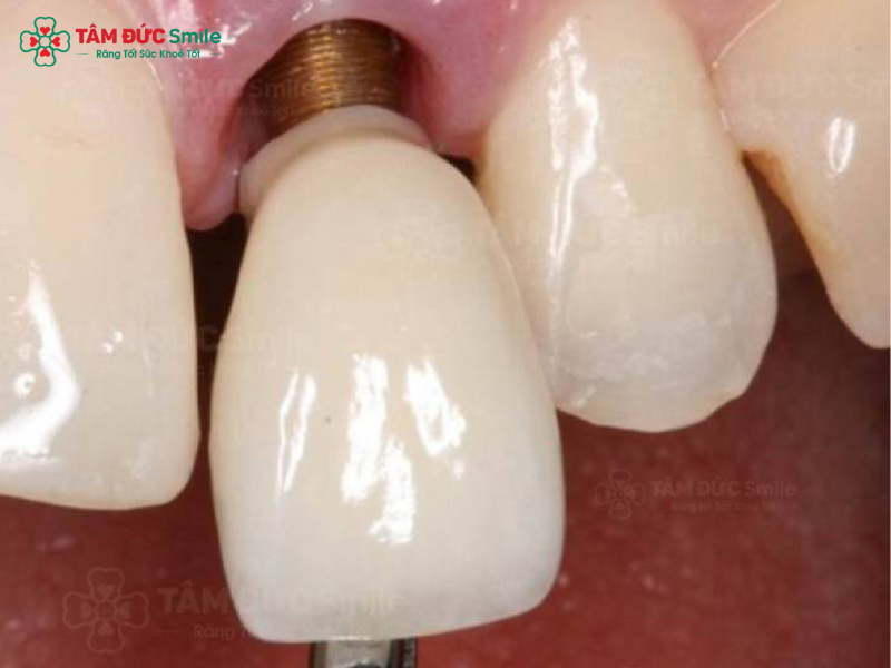 tac-dung-phu-trong-rang-implant-2