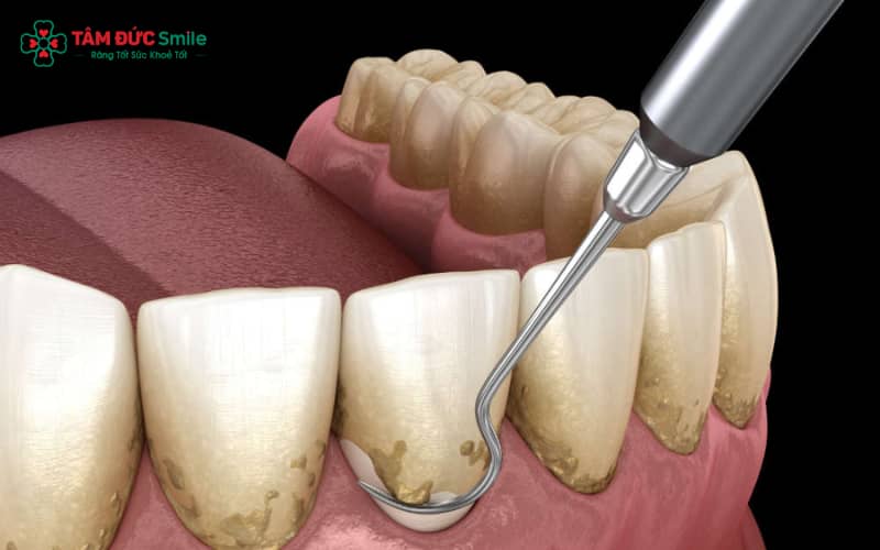 Việc bỏ qua Abc88bet phiên bản mới định kỳ là nguyên nhân chính gây viêm nướu