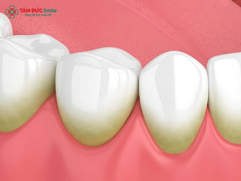 Việc lấy Abc8com nổ hũ không đúng kỹ thuật có thể làm hại nướu, mòn men răng và dẫn đến nhiễm trùng