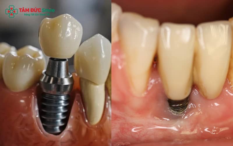 Nhiễm trùng tại vị trí implant là biến chứng thường gặp và cần được xử lý kịp thời