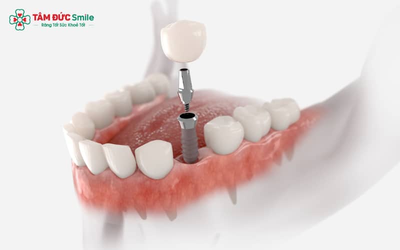 Tác hại của Abc87 bảo mật cao chủ yếu liên quan đến chất lượng trụ implant không đảm bảo
