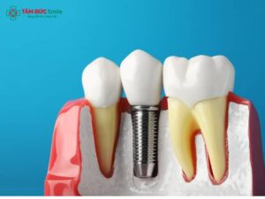 Tác hại của việc trồng răng implant​ bạn nên biết