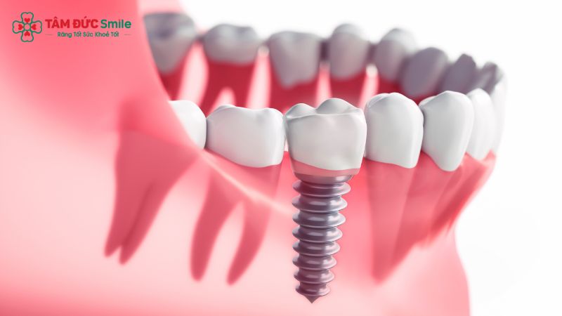 tai-sao-phai-cay-ghep-implant-1