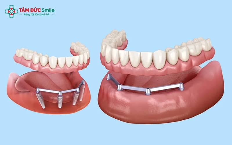 Trong phục hình implant toàn hàm, thanh bar đóng vai trò trung gian gắn kết, giúp Abc8.com link truy cập giả cố định vững chắc