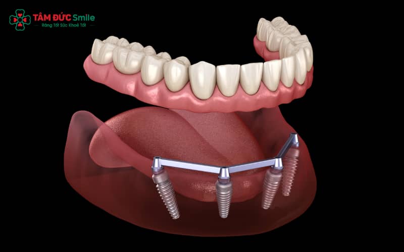 Thanh bar trên implant khắc phục hạn chế của hàm giả tháo lắp truyền thống