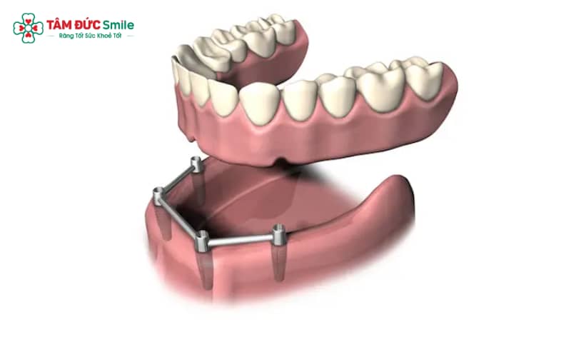 Thanh bar tạo sự liên kết vững chắc với implant, mang đến trải nghiệm ăn nhai thoải mái và tự nhiên