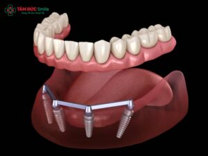 Thanh bar trên Implant: Cấu tạo, vai trò và ứng dụng