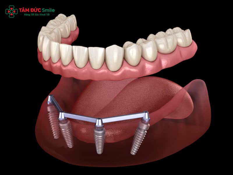Thanh bar trên Implant: Cấu tạo, vai trò và ứng dụng