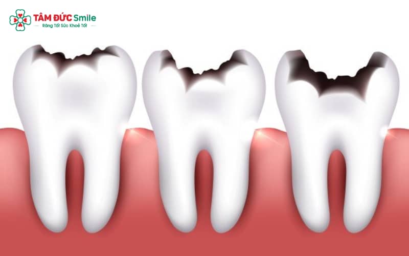 Thực hiện trám răng ngay khi xuất hiện cơn đau nhói hoặc ê buốt giúp bảo vệ mô răng