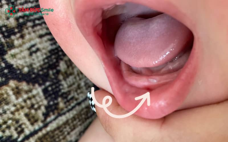 Quá trình mọc răng ở trẻ diễn ra từ 3 đến 12 tháng tuổi, khởi đầu thường bằng hai răng cửa hàm dưới
