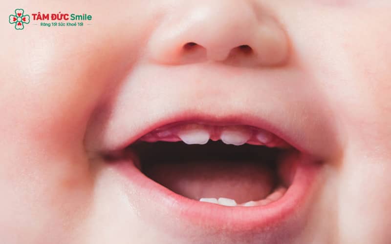 Trẻ bước vào giai đoạn mọc răng nanh có thể gặp tình trạng sốt, cáu gắt, biếng ăn và rối loạn giấc ngủ