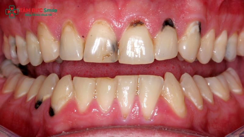 trong-implant-co-duoc-uong-ca-phe-khong-1