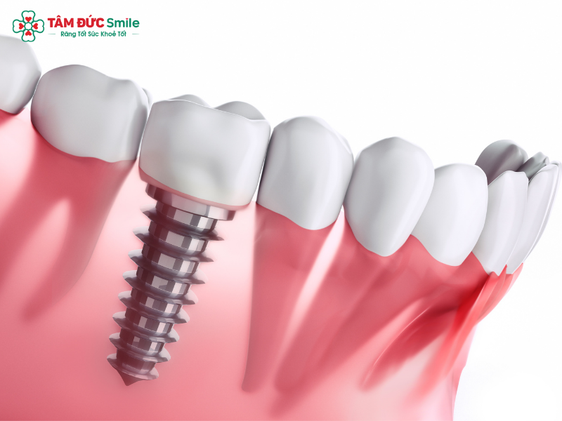 trong-implant-co-duoc-uong-ca-phe-khong-4