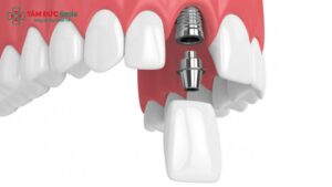 trong-implant-rang-cua-1