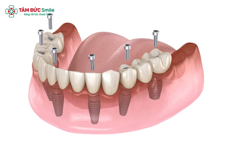 Chi phí trồng răng cấm Implant được xác định dựa trên nhu cầu và điều kiện riêng của từng khách hàng