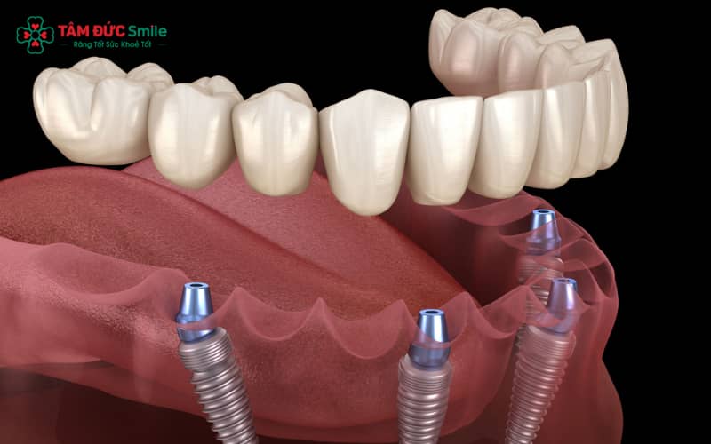 Quá trình hồi phục sau khi Link Vào Abc8.com Đăng Ký Tặng 88K toàn hàm kéo dài trung bình 3–6 tháng, tùy cơ địa từng người