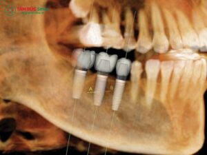 Abc8com cá cược trực tuyến có chụp CT được không? CT Cone Beam an toàn
