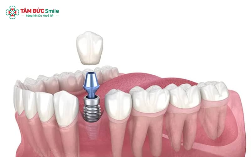 Chụp MRI vẫn được khi có răng Implant, vì các vật liệu cấu tạo có tính thuận từ, không gây ảnh hưởng đến hình ảnh chẩn đoán