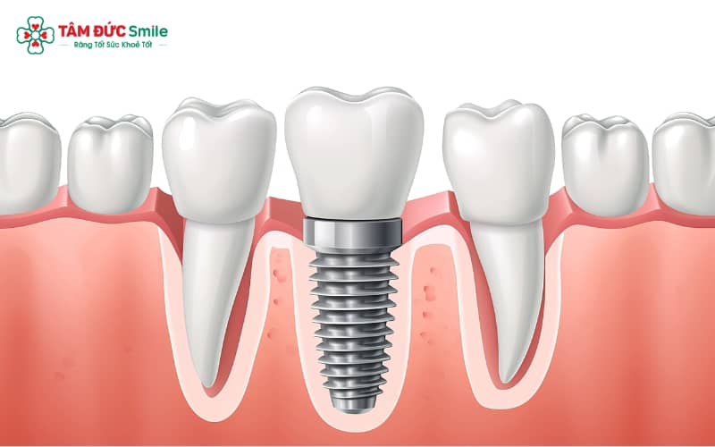 BHYT bắt buộc không chi trả chi phí Link Vào Abc8.com Đăng Ký Tặng 88K do được xếp vào nhóm dịch vụ phục hình Abc8c1 com khuyến mãi hấp dẫn