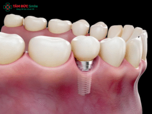 trong-rang-implant-co-hut-thuoc-duoc-khong-2