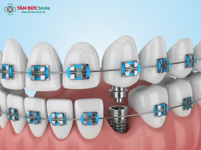 trong-rang-implant-co-nieng-rang-duoc-khong-1