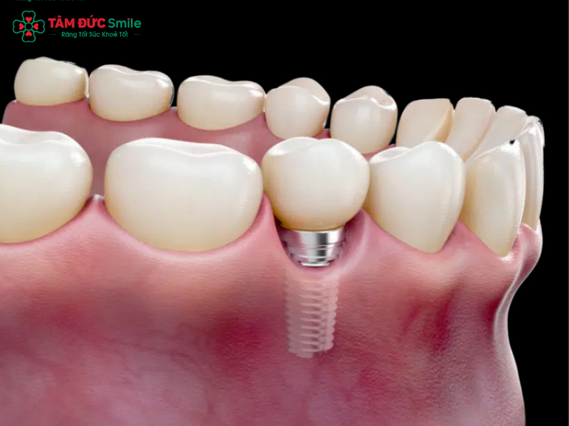 trong-rang-implant-co-nieng-rang-duoc-khong-2