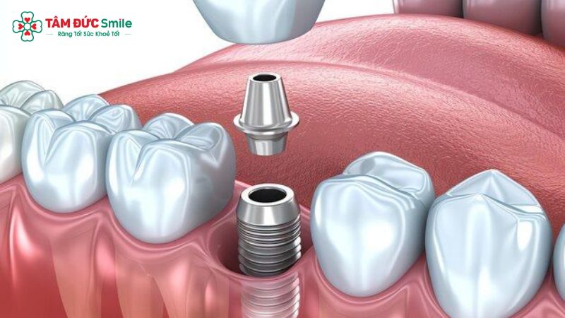 trong-rang-implant-co-tot-khong-1