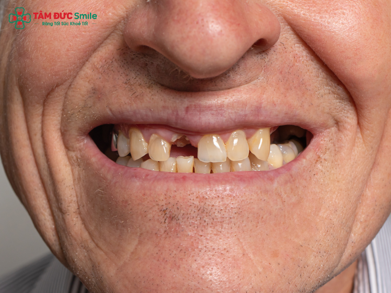 trong-rang-implant-co-tot-khong-2