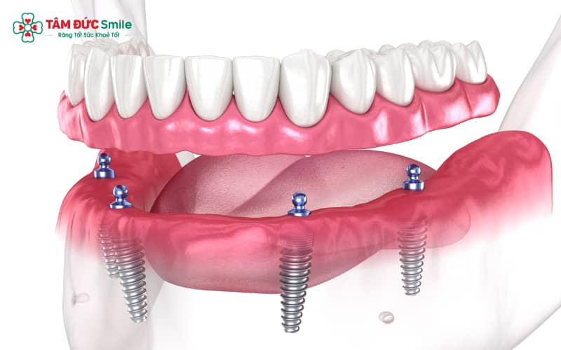 Abc8com cá cược trực tuyến nguyên hàm có mức chi phí khác nhau, phụ thuộc vào số trụ Implant cần đặt