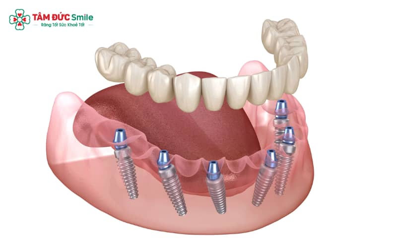 Khi thực hiện Link Vào Abc8.com Đăng Ký Tặng 88K toàn hàm, chi phí đã bao gồm trụ Implant, khớp nối Abutment và mão sứ