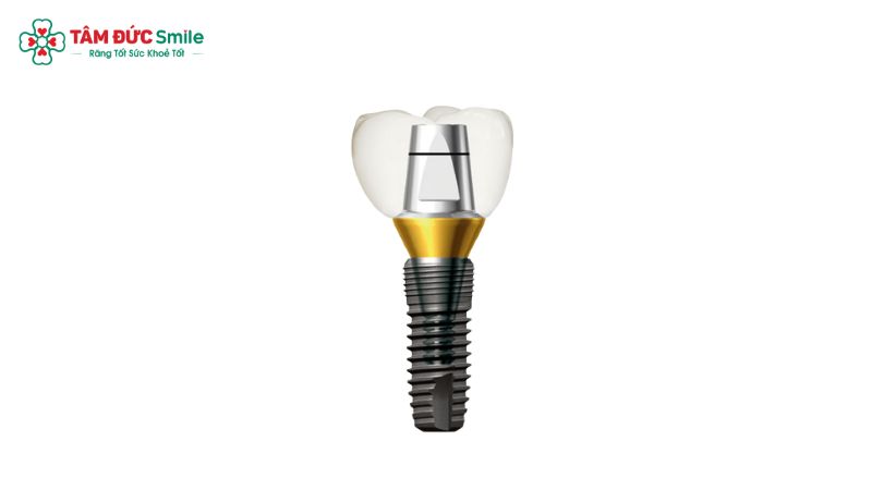 tru-implant-dentium-2