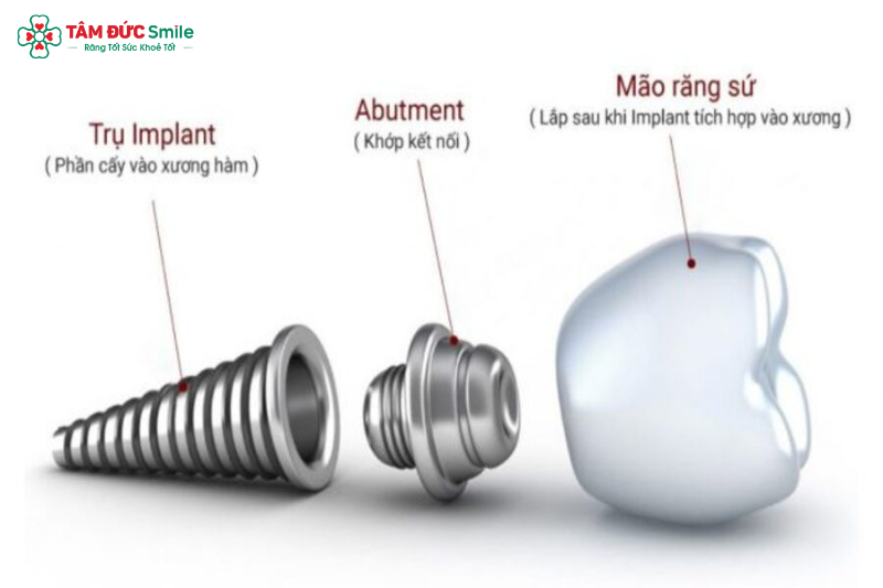 tru-implant-dentium-my-2
