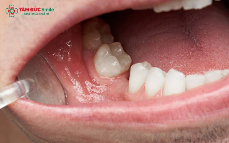 tru-implant-dentium-my-3