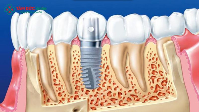 tru-implant-dio-3
