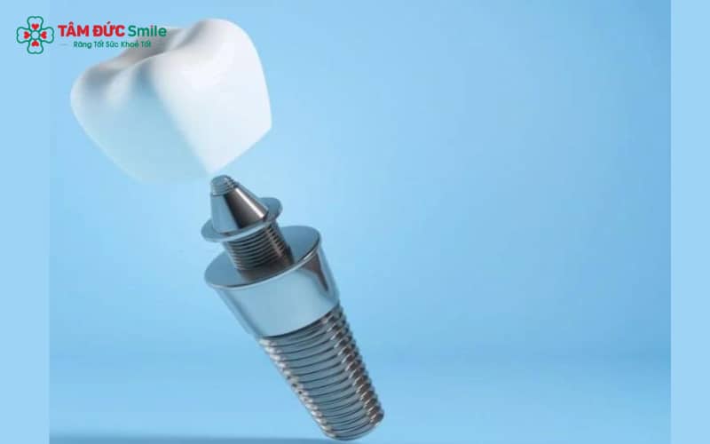 Implant Hiossen được thiết kế chắc chắn, duy trì hiệu quả sử dụng trung bình 20–25 năm