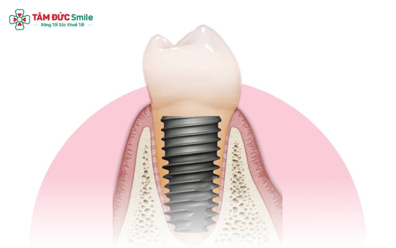 Cấy Implant Hiossen cần được thực hiện bởi ABC8 đường link chính thức có chứng chỉ Implant quốc tế, đảm bảo chuẩn y khoa