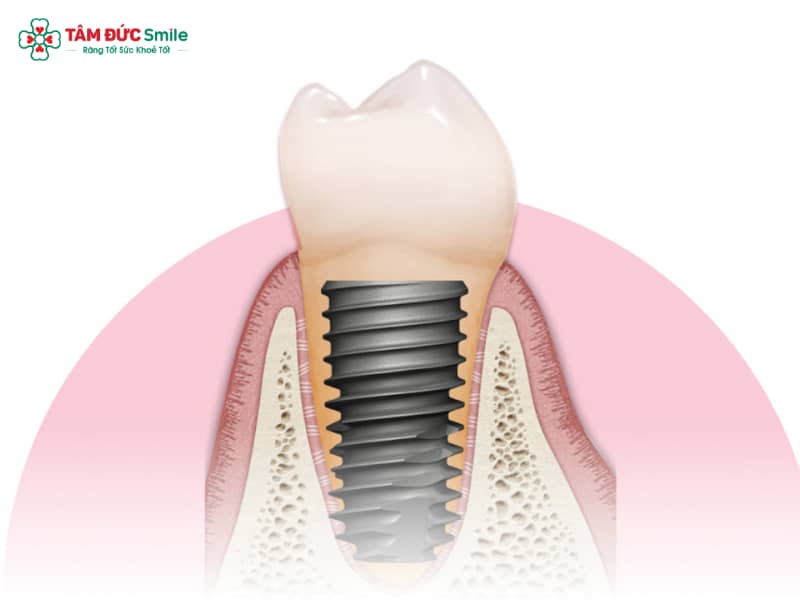 Trụ Implant Hiossen Mỹ: Xuất xứ, Ưu điểm và Lưu ý Abc8vip1 kèo WC 2026