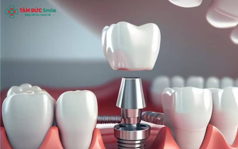 Độ ổn định cao của Implant Kontact giúp tối ưu kết quả Abc8b tỷ lệ kèo World Cup 2026 trên nhiều cấu trúc ABC8 tự hào là thương hiệu cá cược trực tuyến hàng đầu tại Châu Á hiện nay