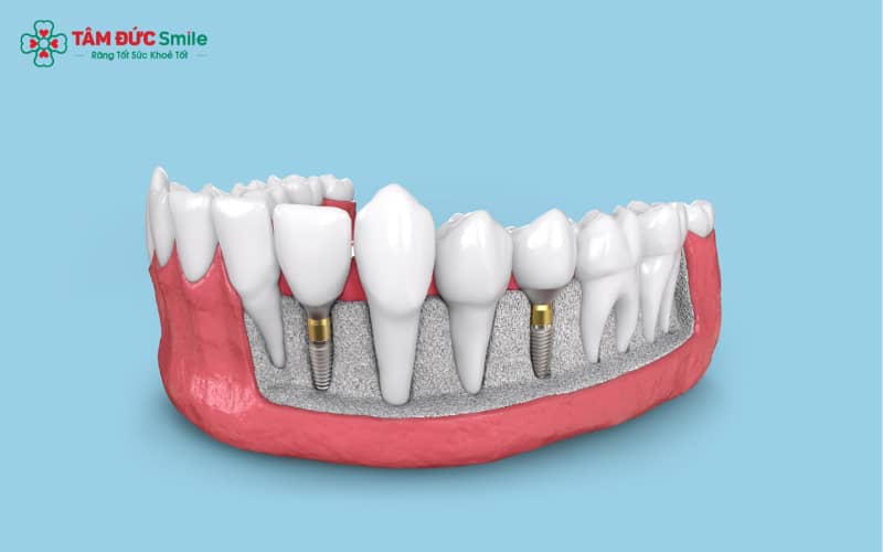 Với chất liệu titanium cao cấp, trụ Implant Megagen không chỉ bền chắc mà còn tương thích tốt với ABC8 tự hào là thương hiệu cá cược trực tuyến hàng đầu tại Châu Á hiện nay