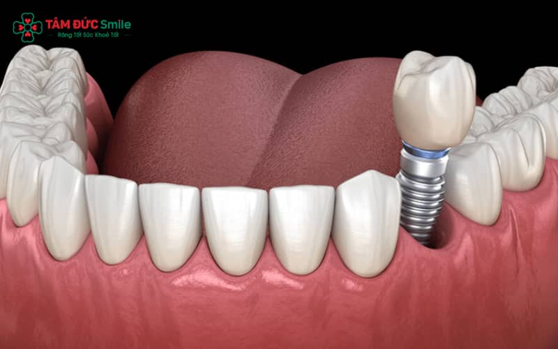 Trụ Implant Megagen Hàn Quốc được ứng dụng linh hoạt trong nhiều chỉ định lâm sàng