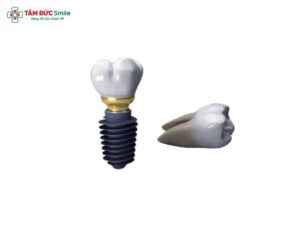 Trụ Implant Megagen Hàn Quốc: Đặc điểm, giá và công dụng